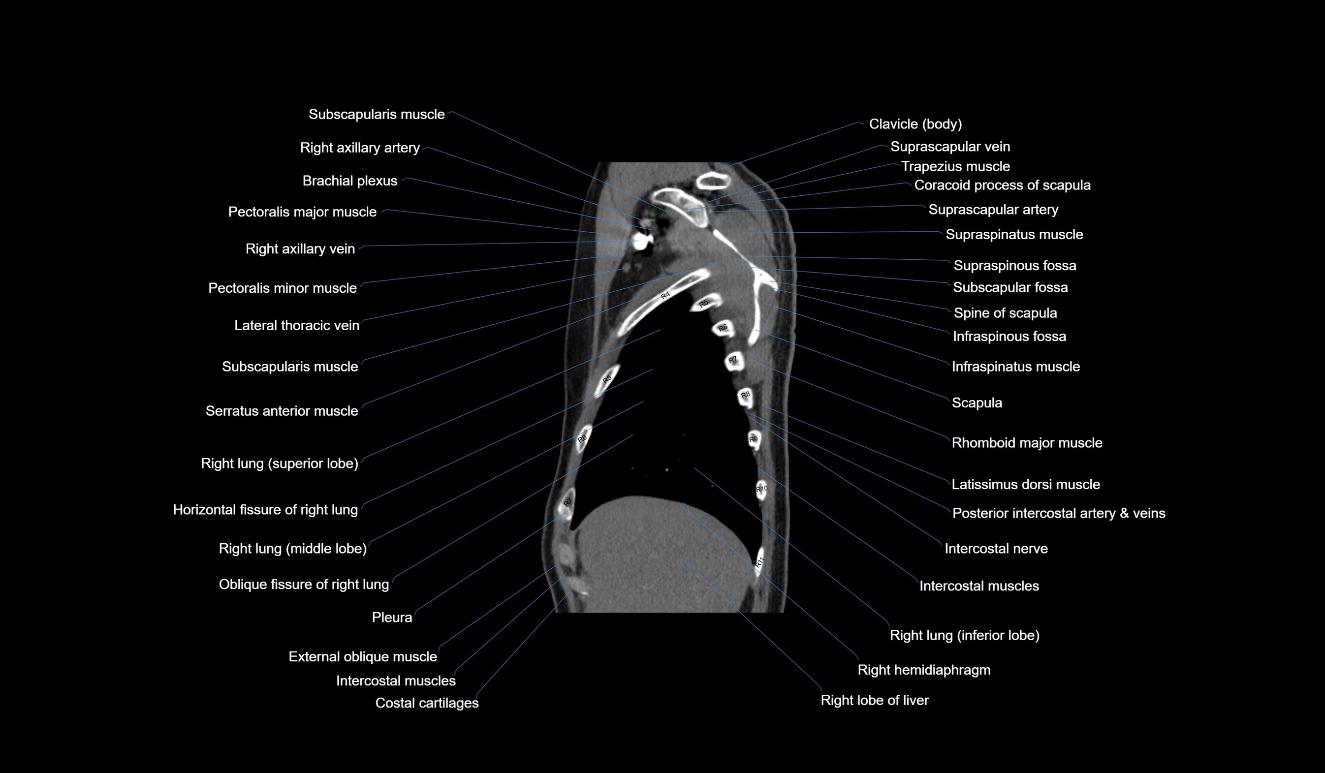 CT chest (thorax) labelled sagittal cross sectional anatomy radiology image-00025.webp